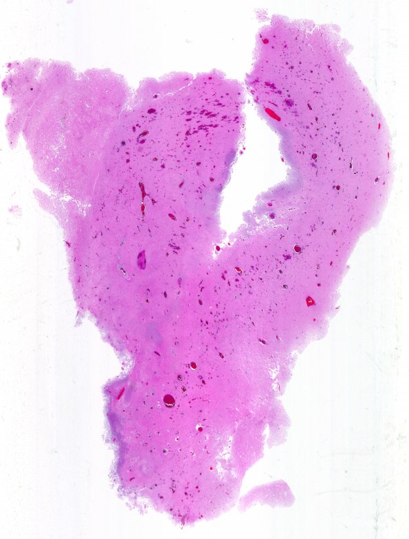 21B2 Meningioma, WHOII, brain invasion (Case 21) N15 WM