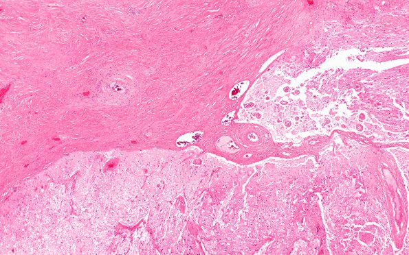 21B3 Meningioma, WHOII, brain invasion (Case 21) N17 4X