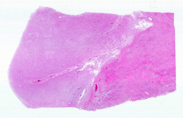 21B4 Meningioma, WHOII, brain invasion (Case 21) N17 WM