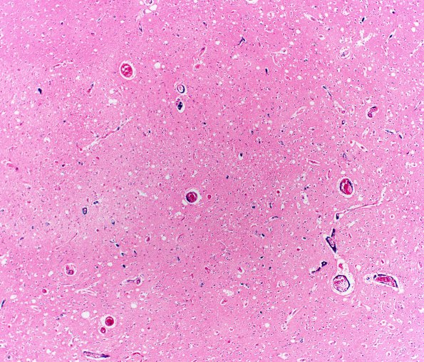 21B5 Meningioma, WHOII, brain invasion (Case 21) N15 4X