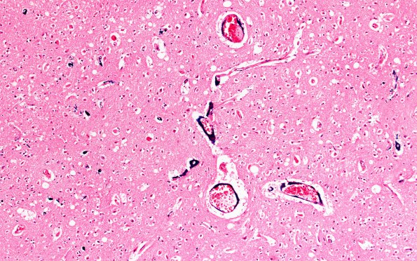 21B6 Meningioma, WHOII, brain invasion (Case 21) N15 10X