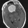 22A1 Meningioma, olfactory groove (Case 22)  T1W - Copy - Copy