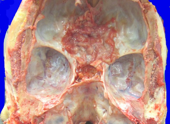 22B1 Meningioma, olfactory groove (Case 22) _7