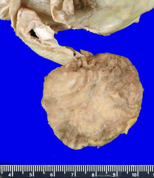 22B3 Meningioma, olfactory groove (Case 22) _9