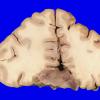 22B4 Meningioma, olfactory groove (Case 22) _12