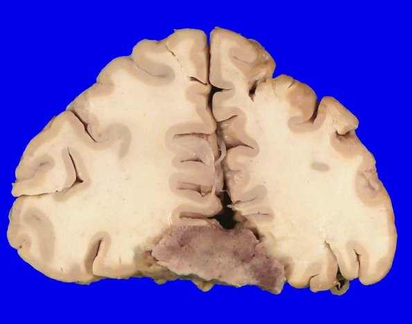 22B4 Meningioma, olfactory groove (Case 22) _12