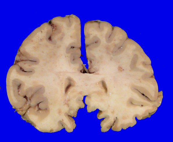 22B5 Meningioma, olfactory groove (Case 22) _10