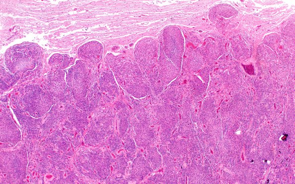 22C1 Meningioma (Case 22) 2X H&E N14 4X H&E