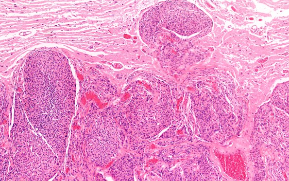 22C2 Meningioma (Case 22) 2X H&E N14 10X H&E