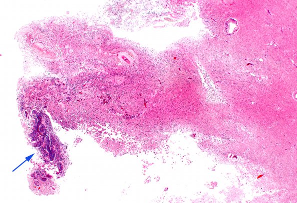 22D2 Meningioma (Case 22) 2X H&E N11 copy