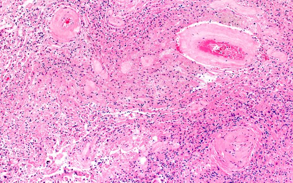 22D3 Meningioma (Case 22) 10X H&E N11