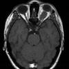 23A1 Meningioma, Optic nerve sheath (Case 23)  Orbit axial T1 - Copy - Copy