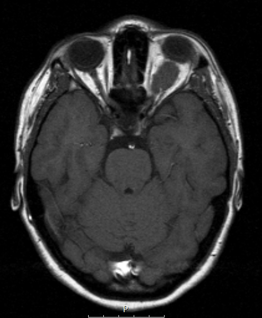 23A1 Meningioma, Optic nerve sheath (Case 23)  Orbit axial T1 - Copy - Copy