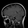 23A2 Meningioma, Optic nerve sheath (Case 23)  Orbit T1 - Copy - Copy