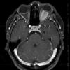 23A3 Meningioma, Optic nerve sheath (Case 23)  T1W axial - Copy