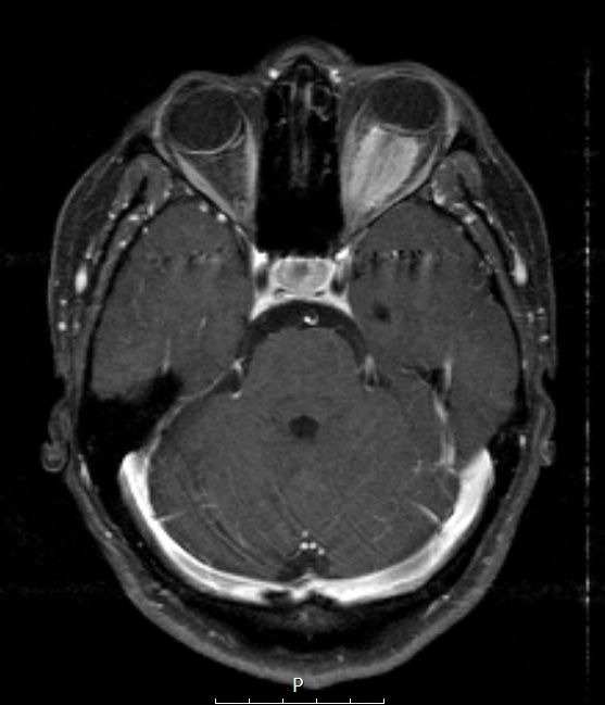 23A3 Meningioma, Optic nerve sheath (Case 23)  T1W axial - Copy