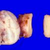 23B1 Meningioma, Optic nerve sheath (Case 23)  1 (2)