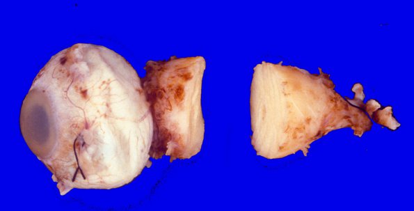 23B1 Meningioma, Optic nerve sheath (Case 23)  1 (2)