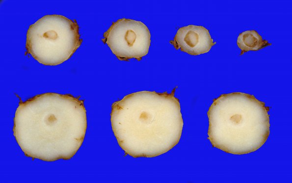 23B2 Meningioma, Optic nerve sheath (Case 23) 2 (2)