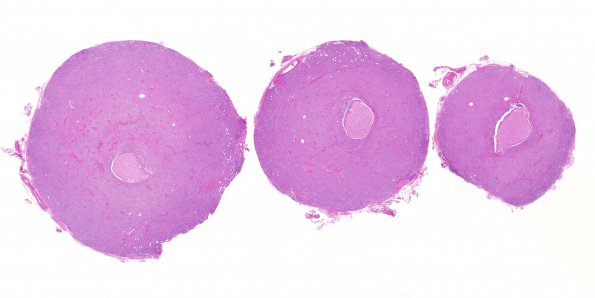 23C1 Meningioma, Optic nerve sheath (Case 23) H&E whole mount 2