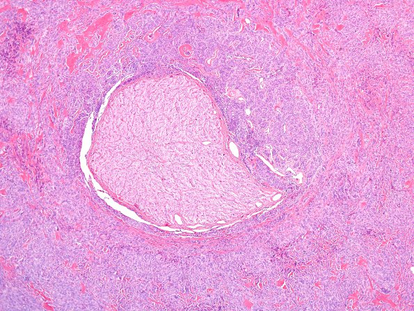 23C2 Meningioma, Optic nerve sheath (Case 23) H&E 4X