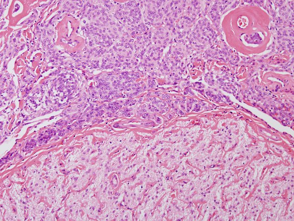 23C3 Meningioma, Optic nerve sheath (Case 23) H&E 20X