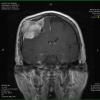 24A Meningioma, whorling sclerosing (Case 24) MRI 4 - Copy