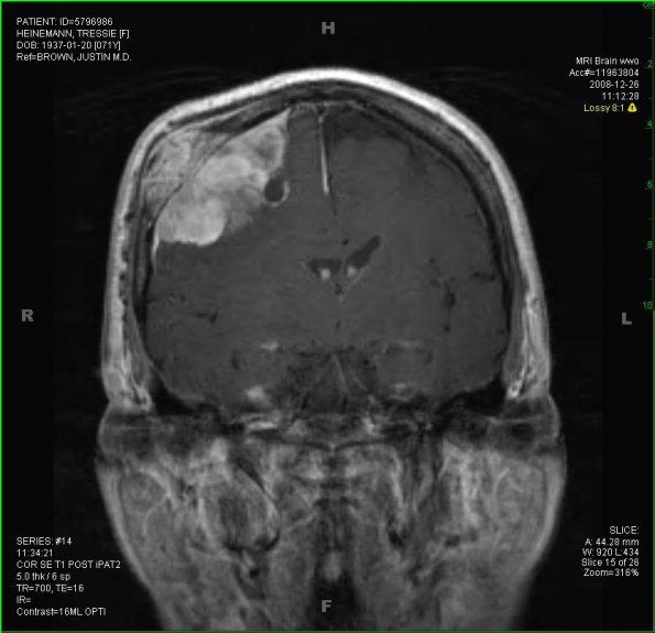 24A Meningioma, whorling sclerosing (Case 24) MRI 4 - Copy