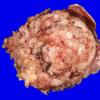 24B1 Meningioma, whorling sclerosing (Case 24) gross _2