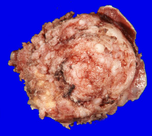 24B1 Meningioma, whorling sclerosing (Case 24) gross _2