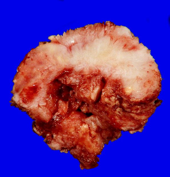 24B2 Meningioma, whorling sclerosing (Case 24) gross _4