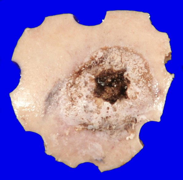 24B3 Meningioma, whorling sclerosing (Case 24) gross _5