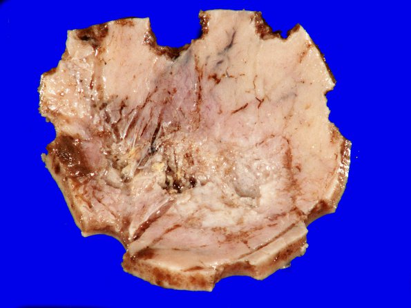 24B4 Meningioma, whorling sclerosing (Case 24) gross _6