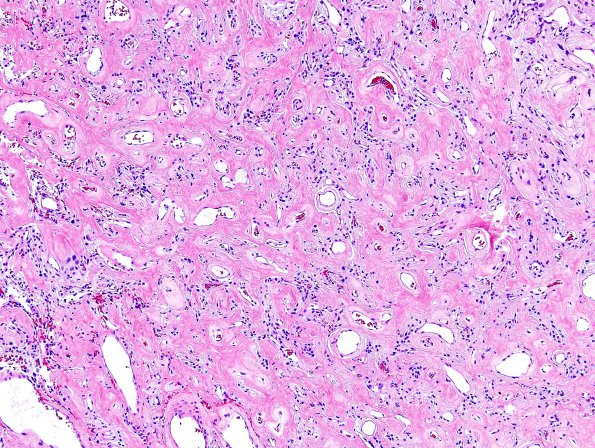 24C1 Meningioma, whorling sclerosing (Case 24) H&E 12