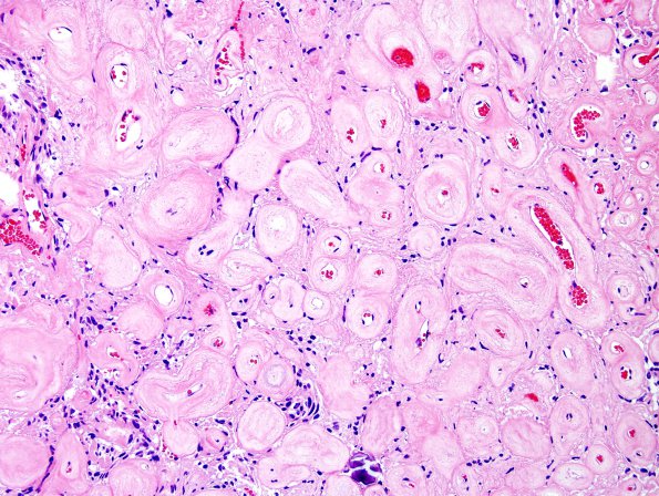 24C2 Meningioma, whorling sclerosing (Case 24) H&E 11