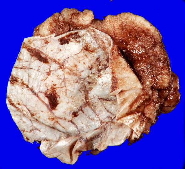 25A1 Meningioma (Case 25) 2