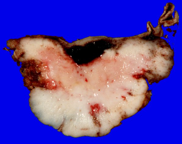 25A3 Meningioma (Case 25) 4