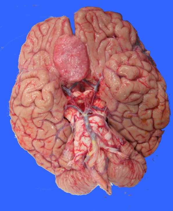 26A1 Meningioma, olfactory groove (Case 26)_1