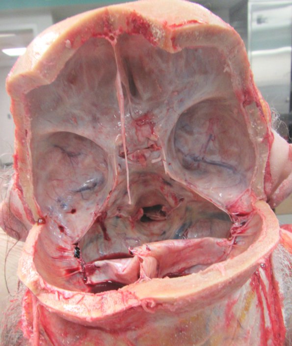 26A2 Meningioma, olfactory groove (Case 26)_2