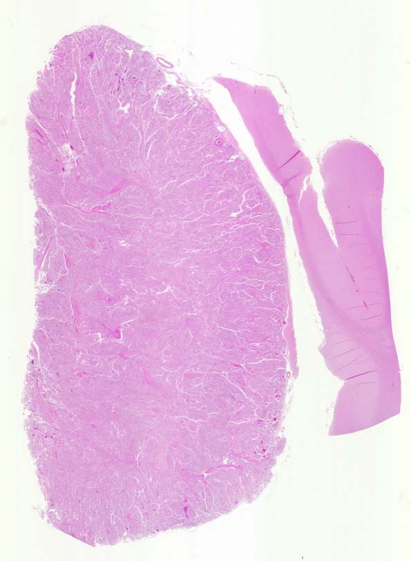 26B1 Meningioma (Case 26) H&E N12