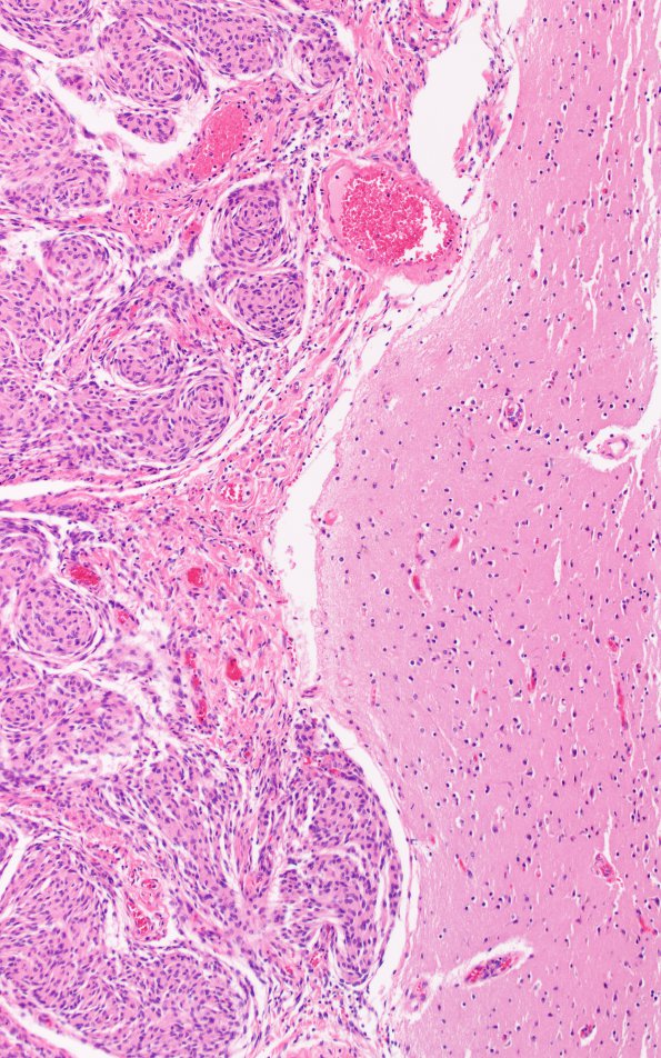 26B2 Meningioma (Case 26) H&E N12 10X