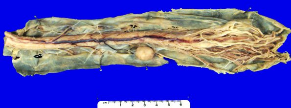 27A1 Meningioma (Case 27) 18