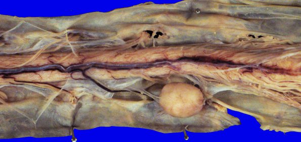 27A2 Meningioma (Case 27) 17