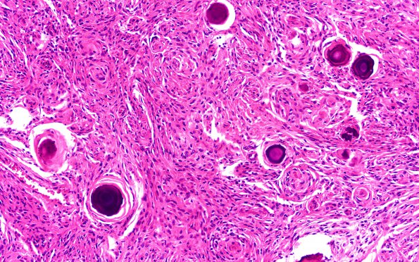 27B2 Meningioma (Case 27) 20X