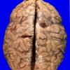 28A2 Meningioma (Case 28) _1