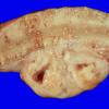 29 Meningioma (Case 29) skull