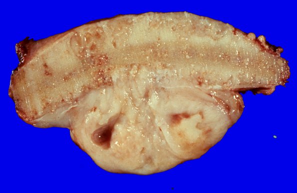 29 Meningioma (Case 29) skull