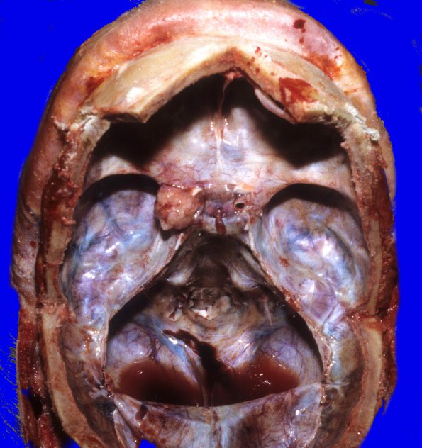 2A1 Meningioma, suprasellar (Case 2) 1