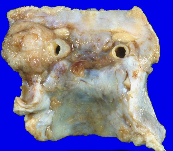 2A2 Meningioma (Case 2)