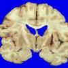 2A3 Meningioma, suprasellar (Case 2) 5